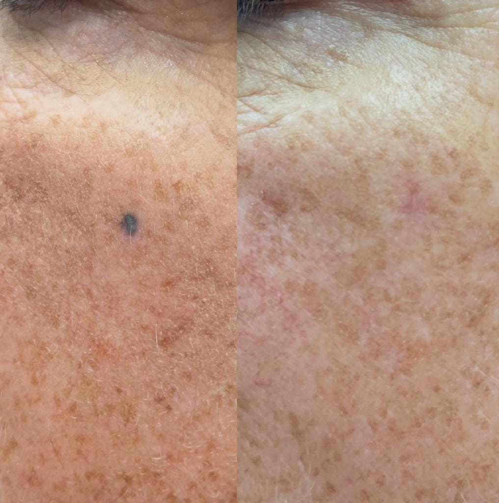 Blue nevus on cheek before surgical excision
