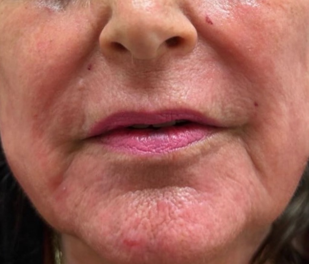Improved skin smoothness two weeks after CO2 laser resurfacing