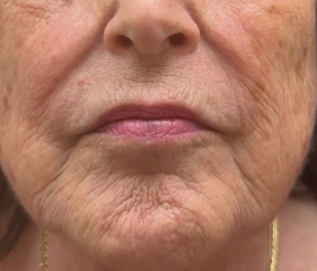 Perioral lines and skin texture before CO2 laser resurfacing