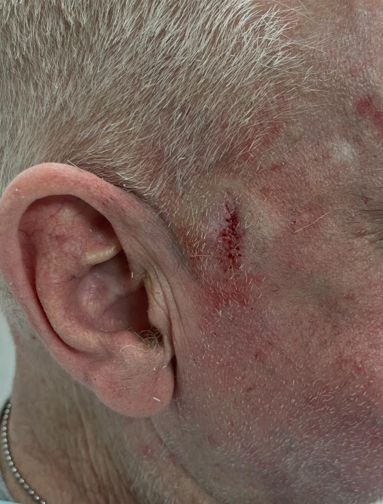 Cyst excision with sutured closure near the ear