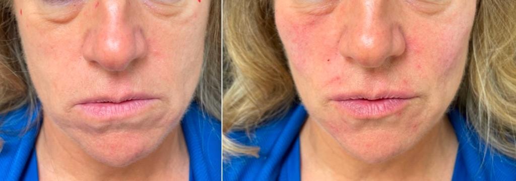 Patient before dermal HA filler treatment showing volume loss in lips, cheeks, and under-eye area