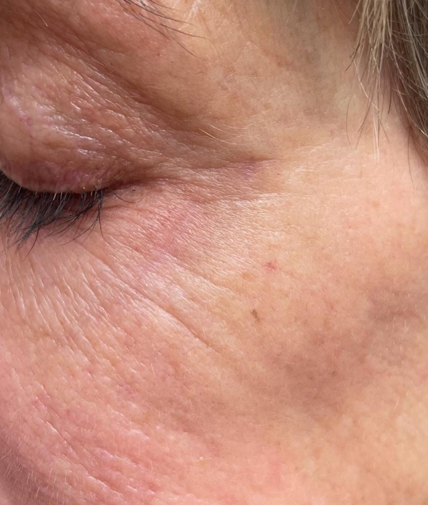 Clear skin beneath the eye after laser vein removal treatment