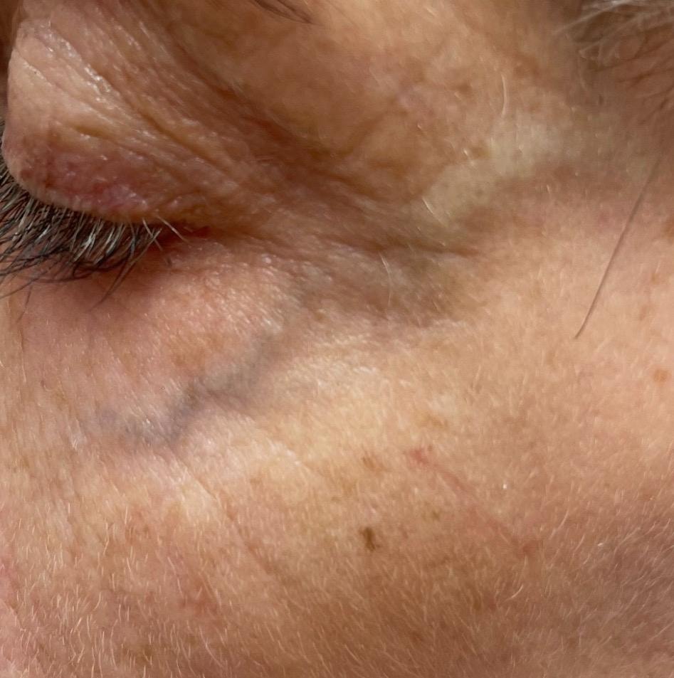 Periorbital veins visible beneath the eye before laser treatment