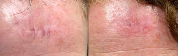Post-Mohs surgery scar with redness and visible vessels before treatment