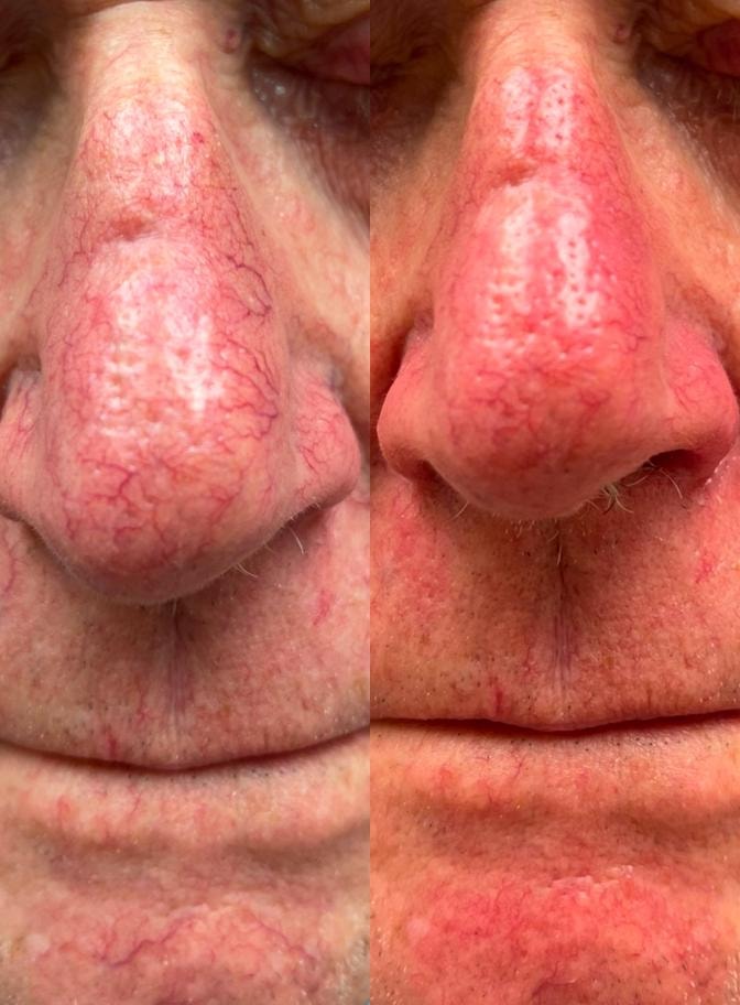 Rosacea before and after vascular laser treatment — side by side comparison showing reduced redness