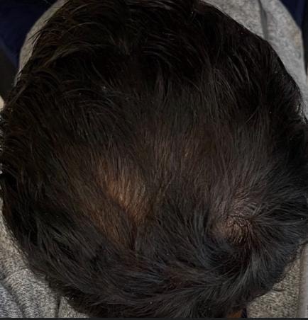 Crown of head showing improved hair density and coverage after alopecia treatment