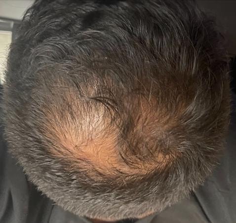Crown of head showing thinning hair and visible scalp before alopecia treatment
