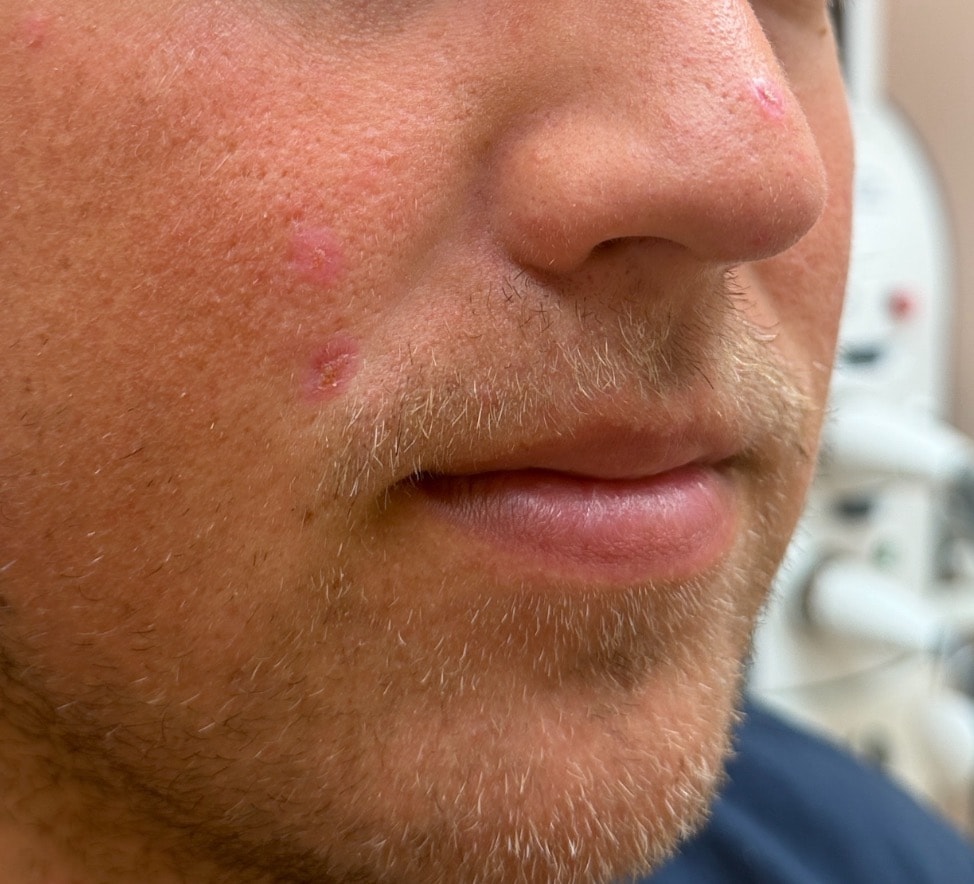 Healing skin 10 days after laser mole removal