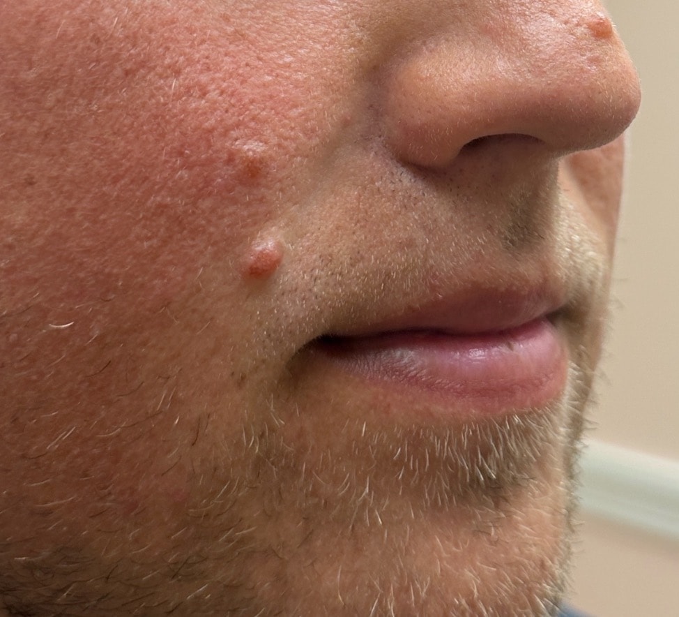 Facial moles before laser removal treatment