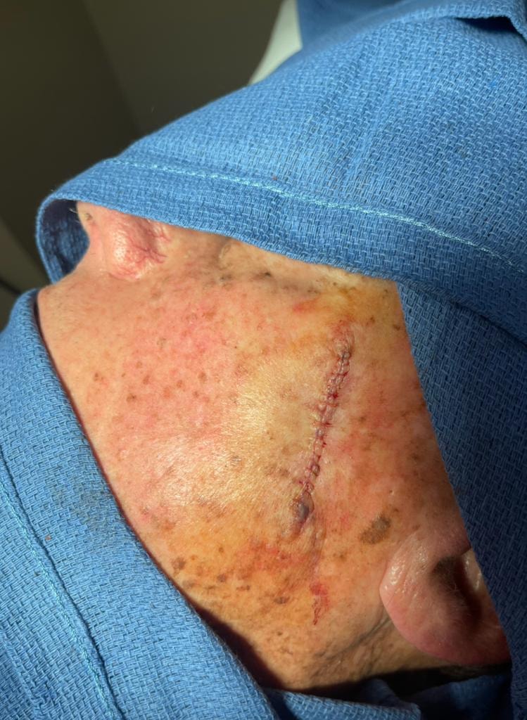 Skin cancer excision with sutured closure